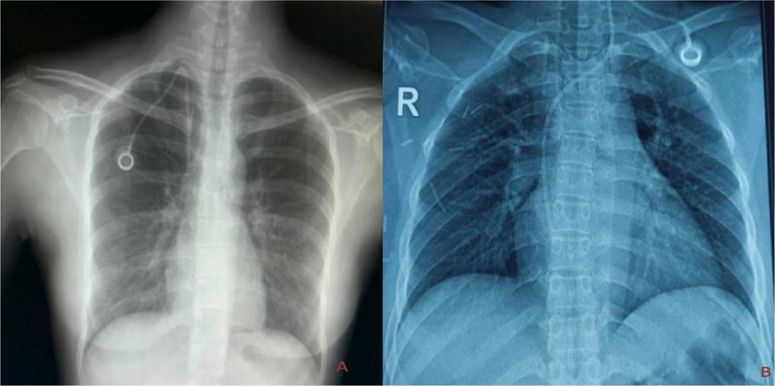 Diagnosis and Management of Central Venous Catheter (Chemoport)-related Complications: Our Experience from Eastern India