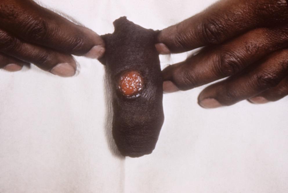 Beyond the Rash: a Review of Cutaneous Manifestation of Sexually Transmitted Infections