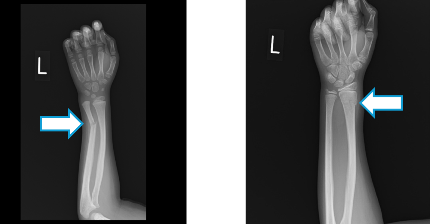 Automated detection of pediatric forearm fractures in X-ray images using deep learning