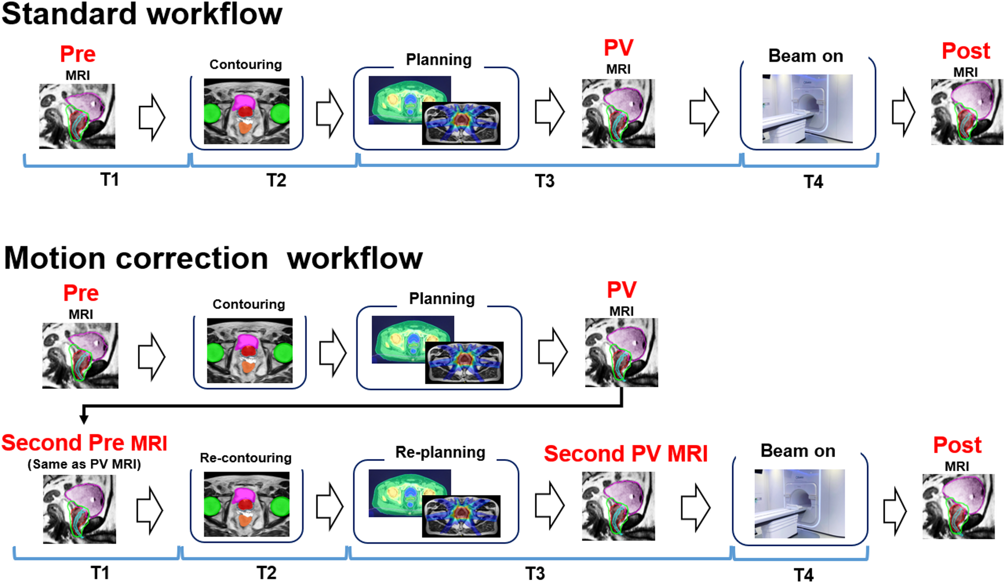 Optimal timing of the cumulative dose and factors related to acute urinary toxicity in prostate cancer treated using magnetic resonance linear accelerator
