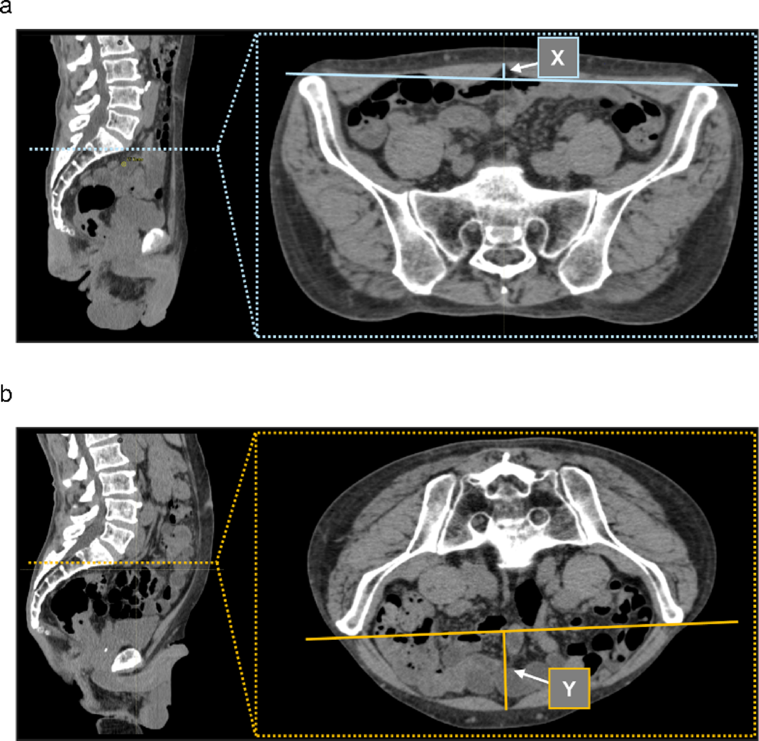 Comparison of small bowel and bladder doses between prone and supine positions in preoperative intensity-modulated radiotherapy for rectal cancer