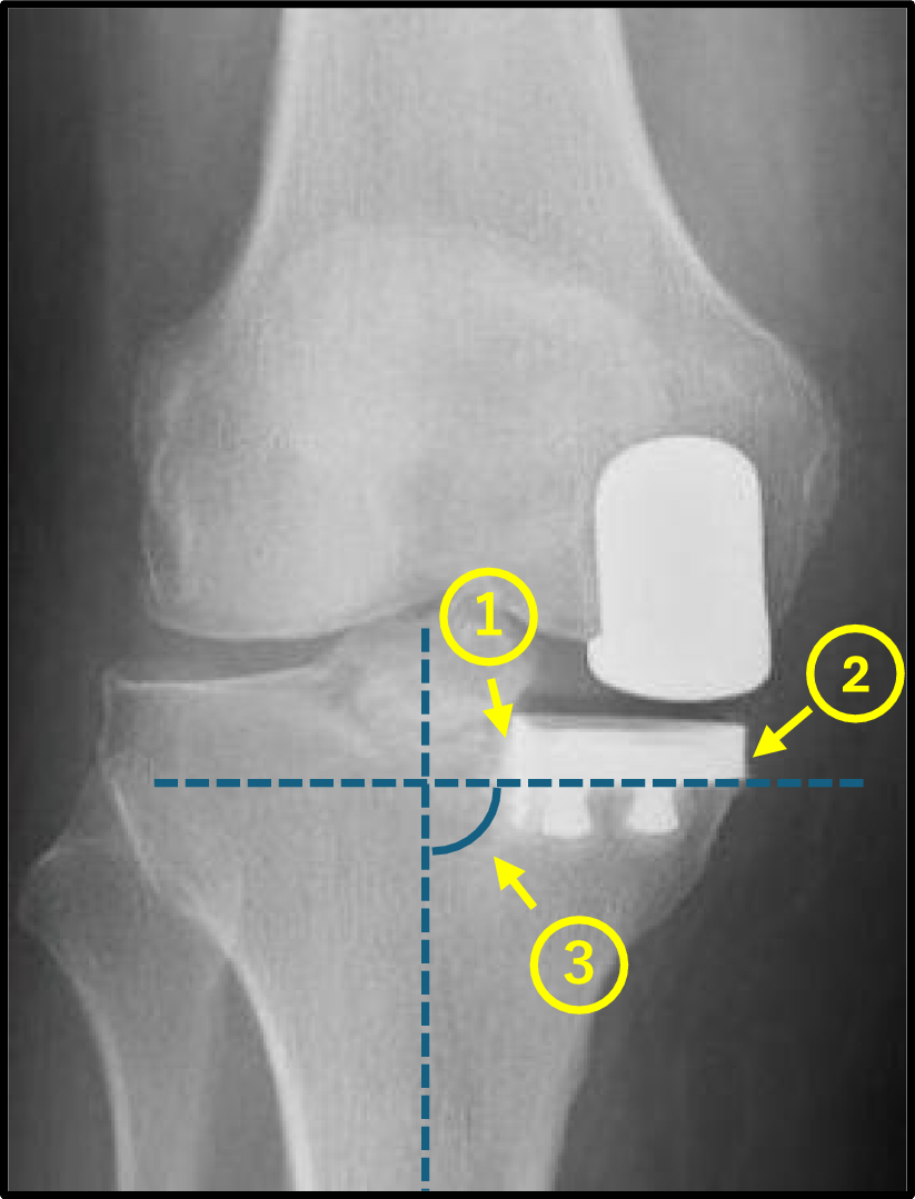 Optimization of postoperative unicompartmental knee arthroplasty radiography using a phantom-based ray-summation positioning sheet