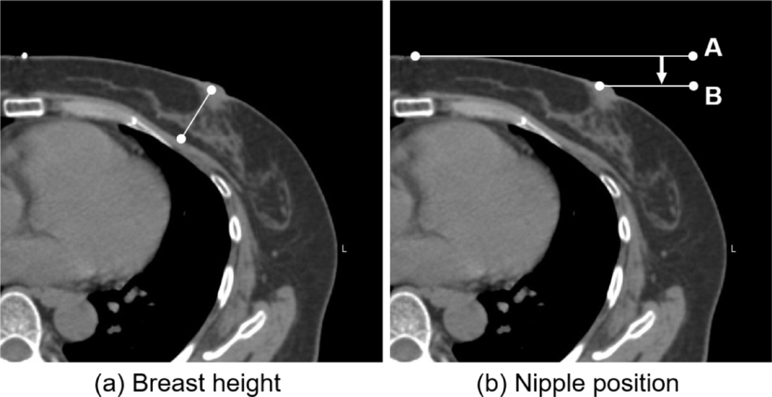 A comparative evaluation of commercial software programs for automatic segmentation in breast cancer radiotherapy planning