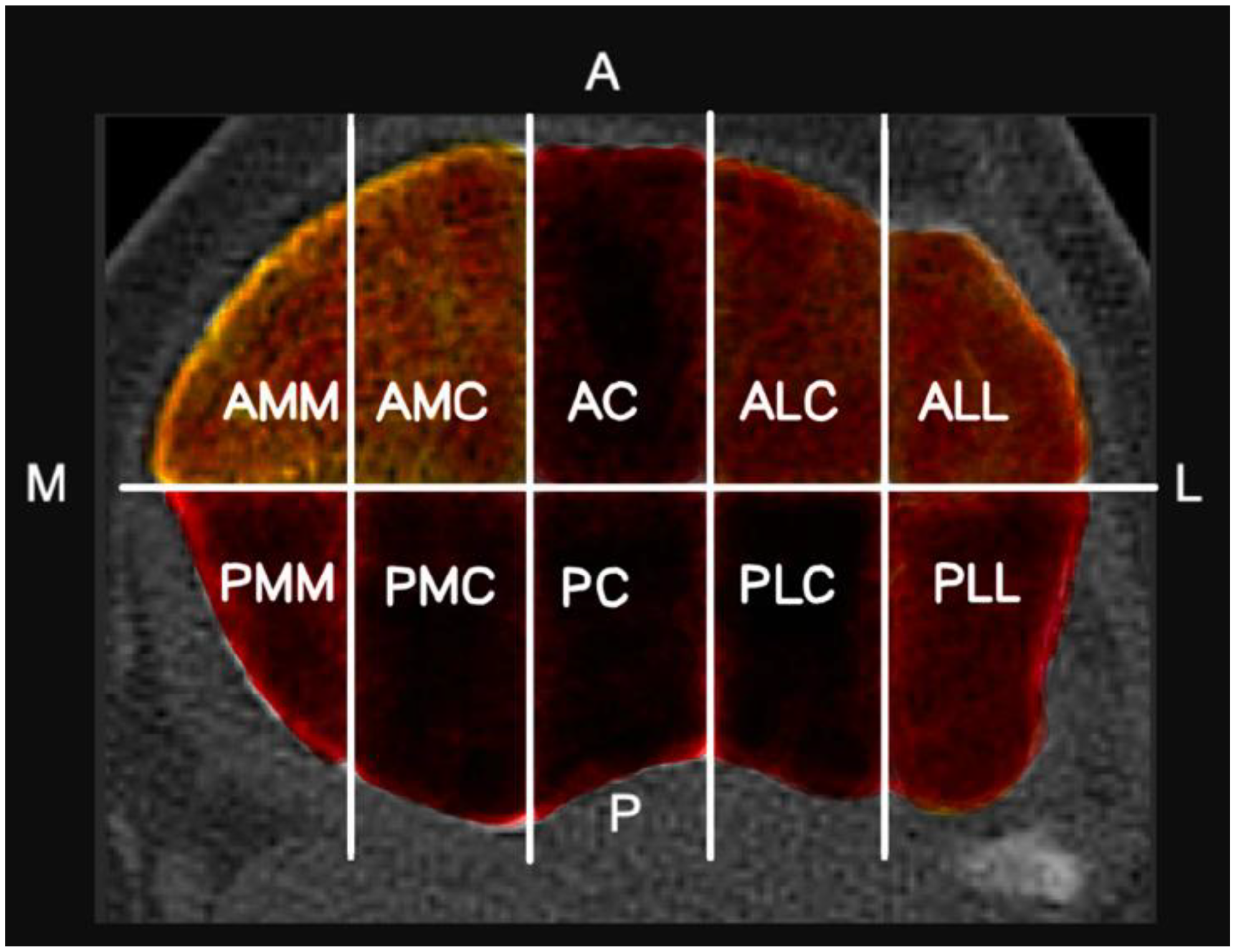 From fracture to joint injury: association between CT-based fracture characteristics and surgically treated non-bony injuries in tibial plateau fractures