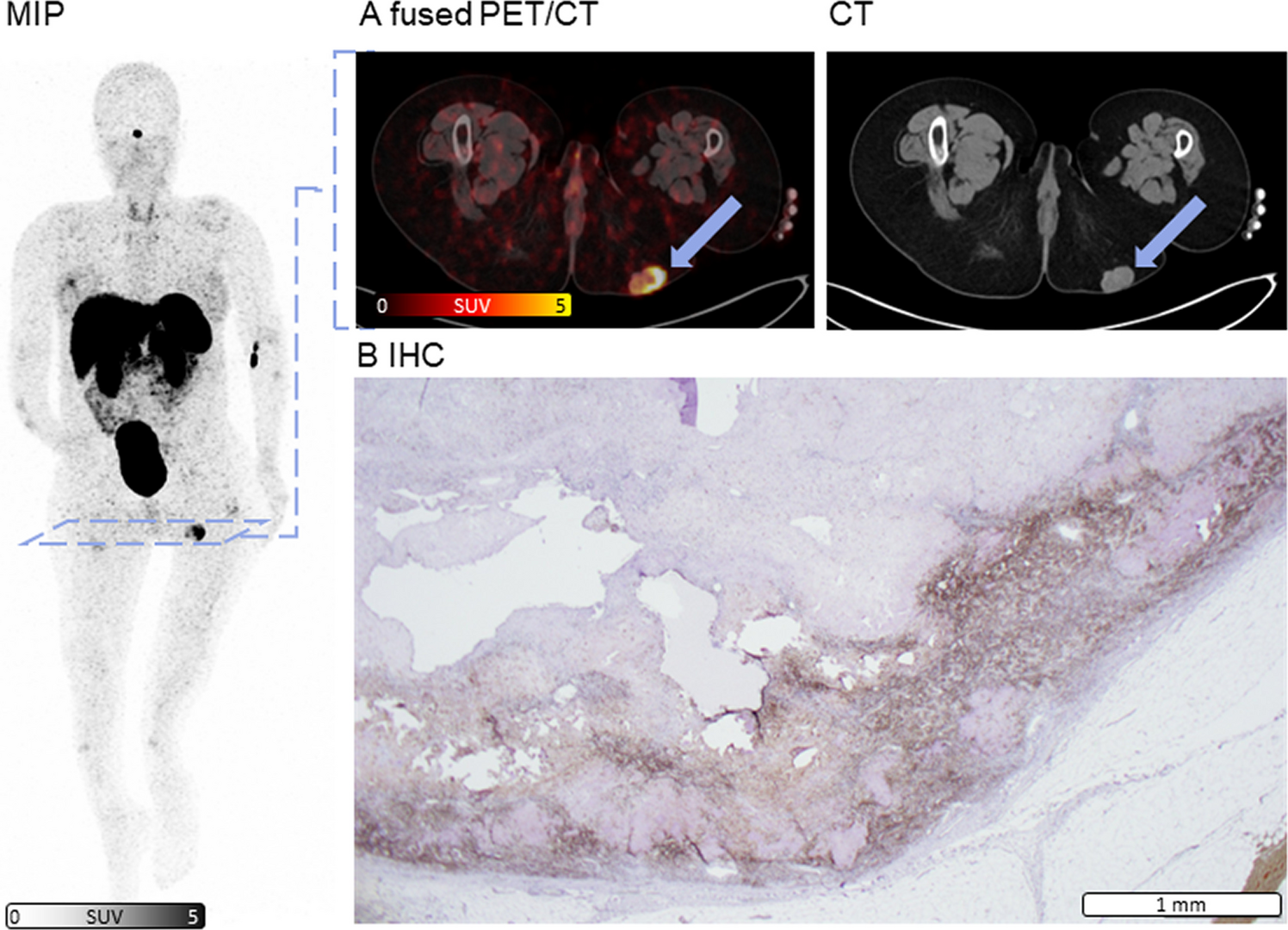Diagnostic Performance of Somatostatin Receptor-directed PET/CT for Tumor-induced Osteomalacia
