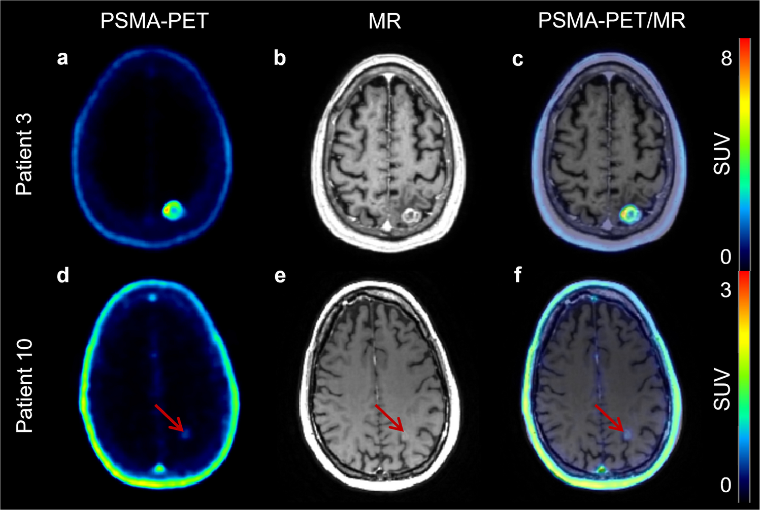 Quantitative [F]PSMA-1007 PET in Treatment Response Monitoring of Brain Metastases from Non-small Cell Lung Cancer
