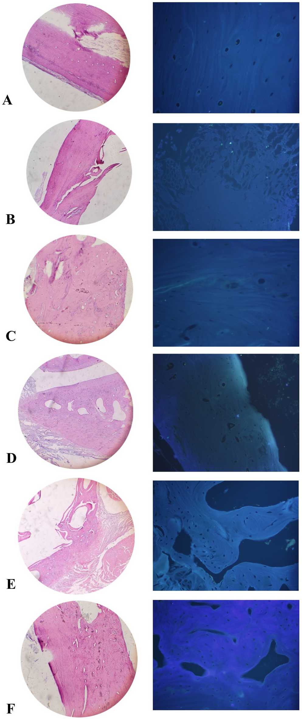 Deferoxamine and Mesenchymal Cells along with Acellular Bone Graft Improved Vascularization Marker and Bone Regeneration in Radius Critical-Size Defect of Rat