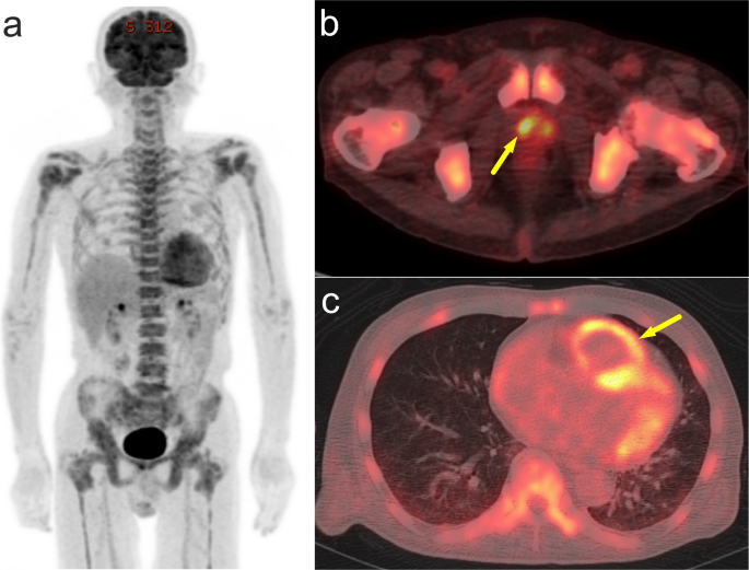 Pulmonary tumor thrombotic microangiopathy associated with prostate cancer achieving over 10-year survival: a case report