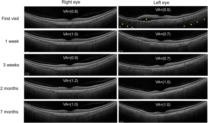 Immune checkpoint inhibitor-associated uveitis in a patient with breast cancer and a remote history of Vogt–Koyanagi–Harada disease: a case report