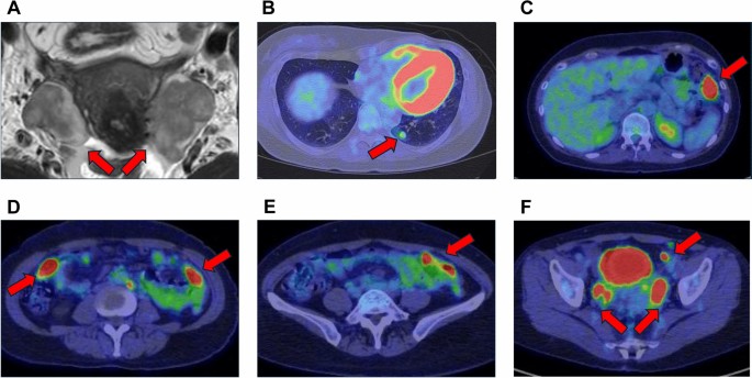 Clinical utility of diagnostic laparoscopy for ovarian metastasis from breast cancer in a -mutated patient with hereditary breast and ovarian cancer syndrome: a case report and literature review