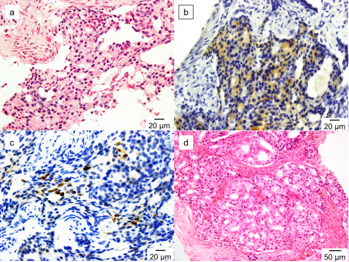 Adenocarcinoma with endometrioid features originating in the male genitourinary tract after hormonal therapy for prostate cancer