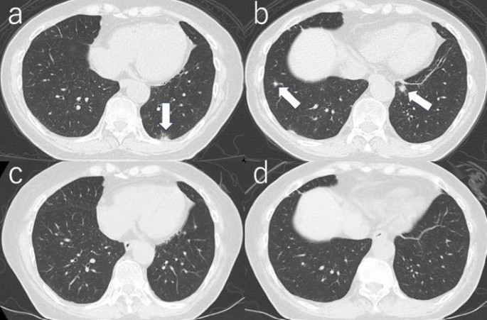 Maintaining complete response to avelumab for lung metastases from native ureteral cancer after kidney transplantation: a case report