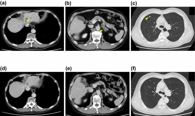 A case of advanced esophagogastric junction cancer in which comprehensive genomic profiling by liquid biopsy led to the diagnosis of a second primary hepatocellular carcinoma