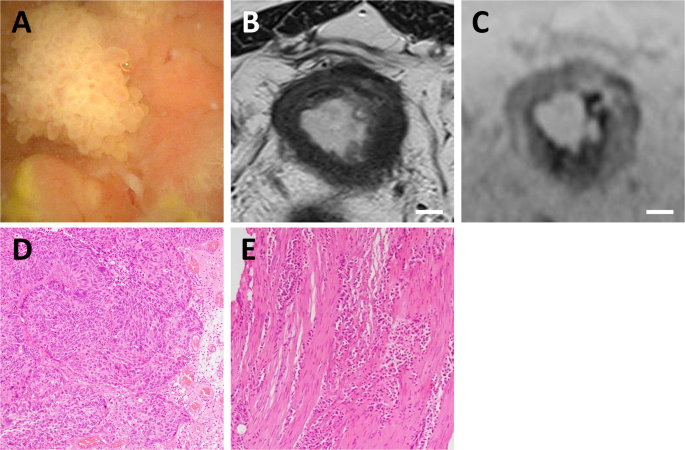 Rapidly progressive synchronous multifocal gastrointestinal stenoses in bladder cancer: diagnostic challenges and clinical implications