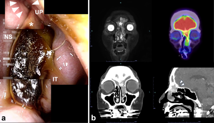 Ewing sarcoma of the frontal sinus in an elderly patient: a case report and review