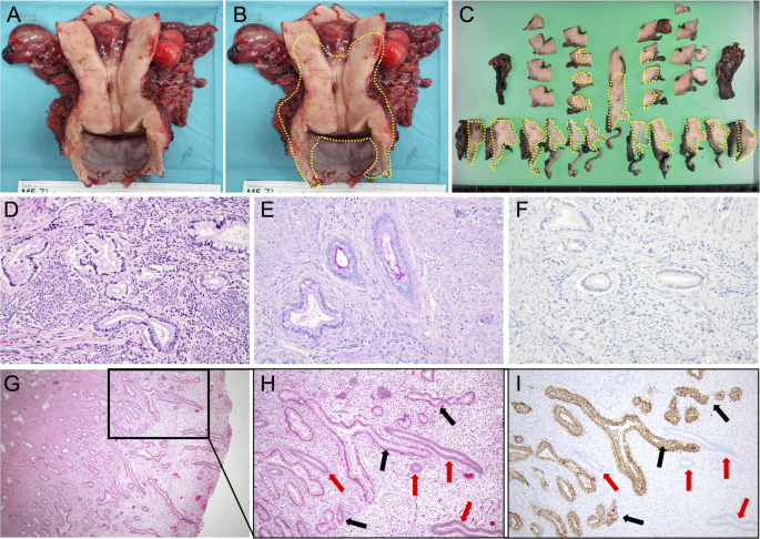 Unique pattern of endometrial invasion in gastric-type adenocarcinoma of the uterine cervix: a report of two cases