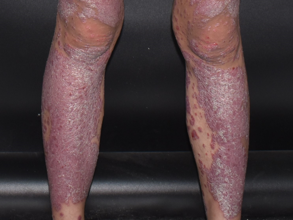 Value of Blood Count–Derived Inflammatory Markers for Evaluating Psoriasis Severity: Pilot Cross-Sectional Observational Study