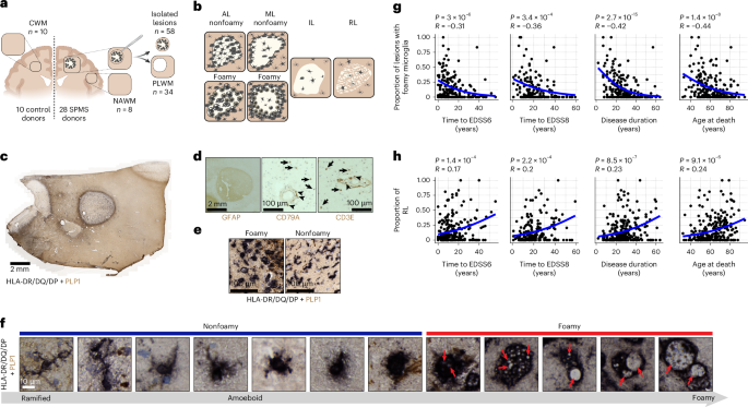 Foamy microglia link oxylipins to disease progression in multiple sclerosis