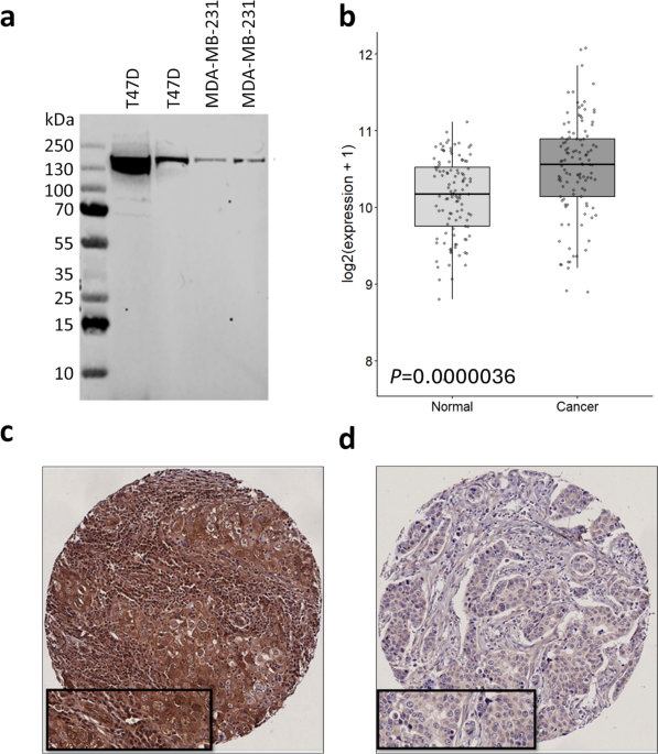 DHX37 protein and mRNA expression patterns in breast and ovarian cancer and their prognostic implications