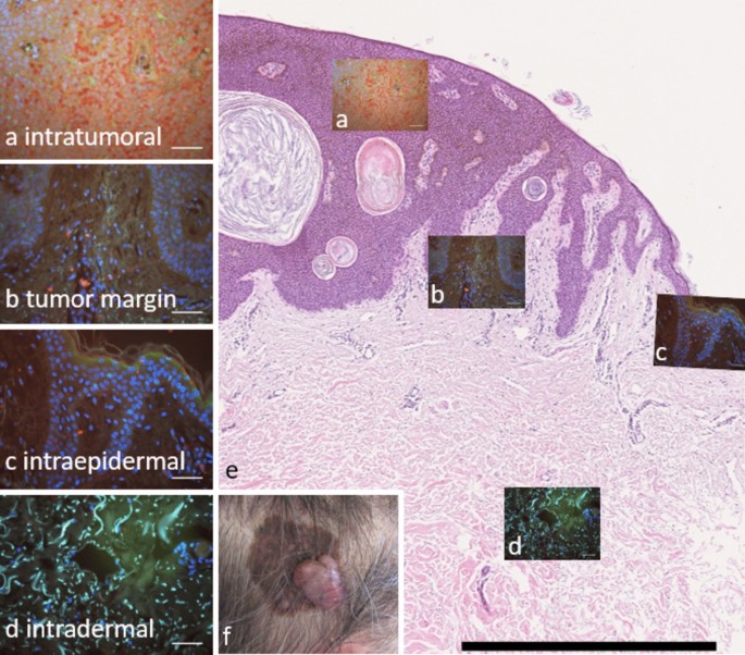 Localization of dendritic cells and T cells within the tumor microenvironment in different types of skin cancer