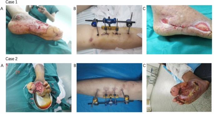 Clinical Study of Modified Tibial Transverse Transport Combined with the Masquelet Technique for the Treatment of Diabetic Foot with Ulcers