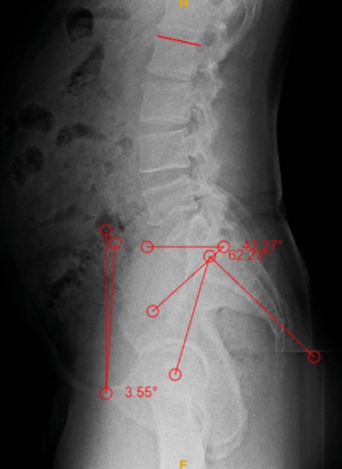 Hip–Spine Evaluation: A Clinical Practice for Total Hip Arthroplasty in Indian Scenario