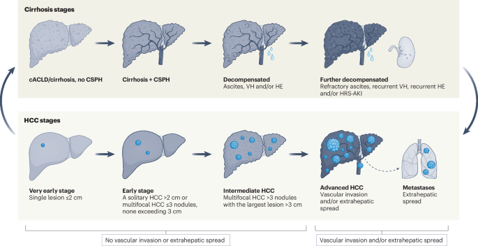 Cirrhosis, portal hypertension and hepatocellular carcinoma: a stage-based approach