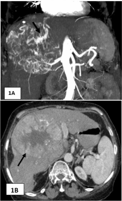Percutaneous Transhepatic Intratumoural Glue Embolization: A Targeted Technique for Lung Shunt Reduction Before Y-90 Radioembolization