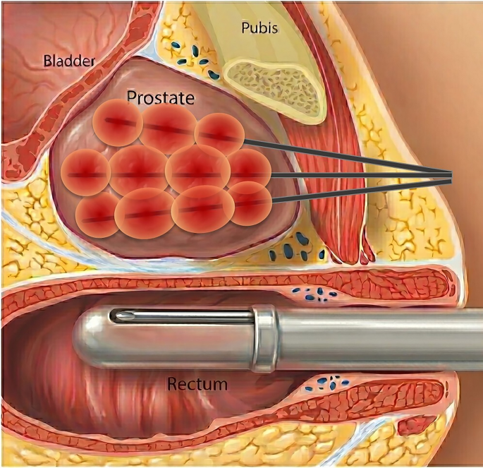 Free-Hand Moving-Shot Technique for Ultrasound-Guided Transperineal Prostate Ablation: A Technical Note