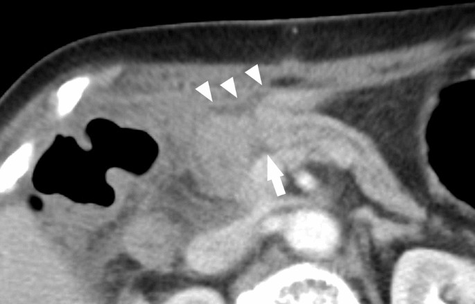 Percutaneous Transjejunal Pancreatic Duct Drainage for Pancreaticojejunostomy Dehiscence Using a Snare-Assisted Technique