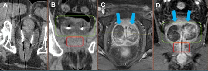 Prostatic Cryoablation to Treat Lower Urinary Tract Symptoms for Benign Prostatic Hyperplasia Patients Not-Responding or Not-Amenable to Prostatic Artery Embolization