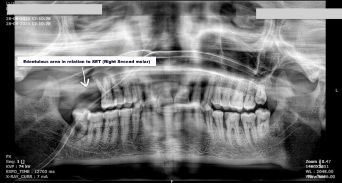Simple Management of a Self-Exfoliated Tooth in an Advanced Oral Cancer Case with Severely Restricted Mouth Opening