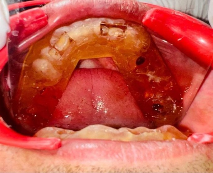 Comparison of 3D Printed and Conventional Surgical Guides for Dental Implant Placement Accuracy: A Clinical Study