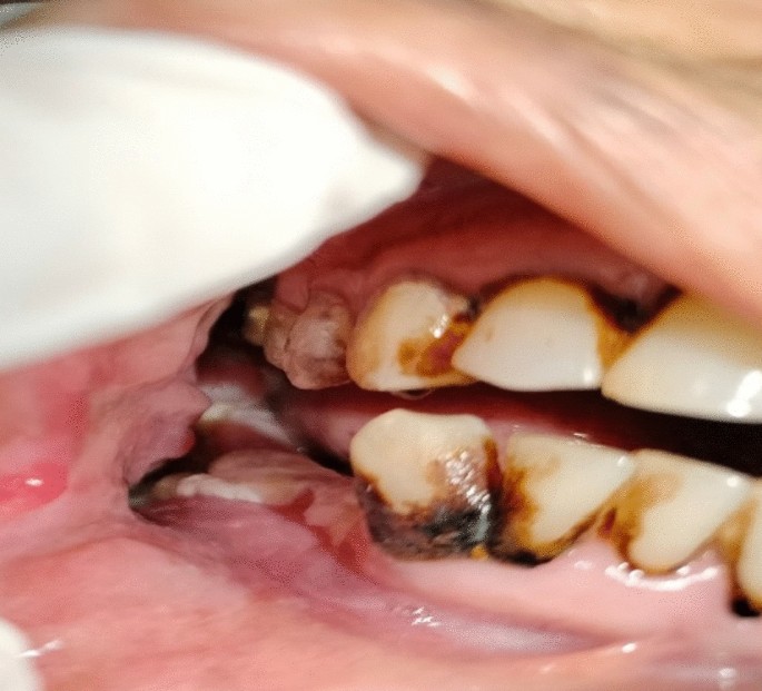 Carcinoma Cuniculatum of the Mandible Mimicking Osteomyelitis: A Diagnostic Challenge