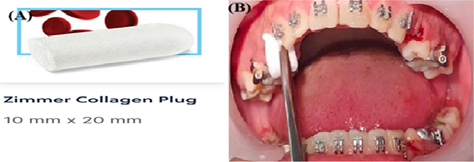 Alveolar Bone preservation of Post-orthodontic Extraction Sockets Using a Standalone Biodegradable Collagen Plug: A Randomized Split-Mouth Clinico–radiographic Study