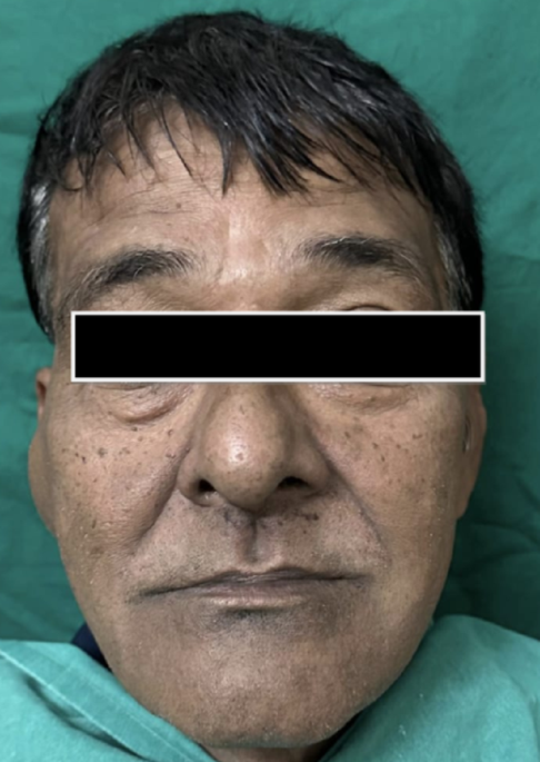 Parotid Gland Myoepithelioma: A Rare Benign Salivary Gland Tumour with Rapid Clinical Progression