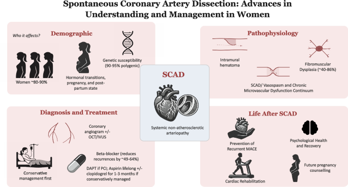 Spontaneous Coronary Artery Dissection: Advances in Understanding and Management in Women