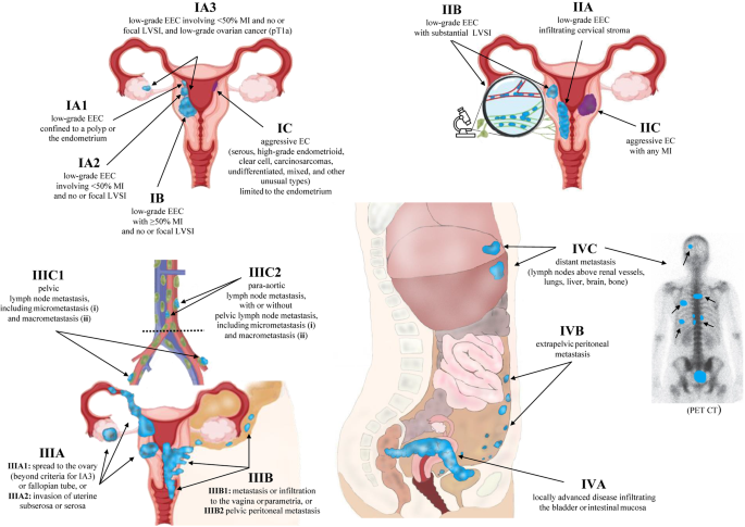 Decoding the 2023 FIGO Staging System in Endometrial Cancer: A Practical, Visually Guided Framework for Molecular Risk-Adapted Care Incorporating the 2025 Risk Group Update