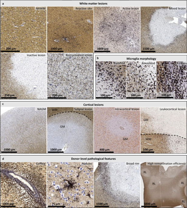Donor-specific pathological features associate with genetic background, lesion type distribution, and clinical heterogeneity in multiple sclerosis