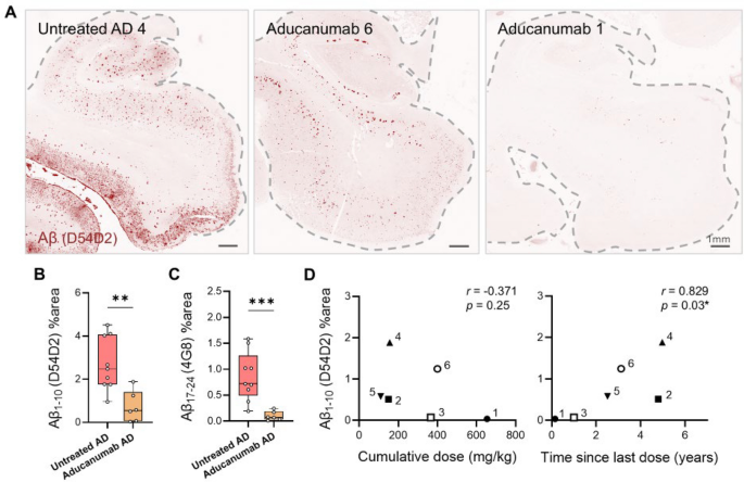 Neuropathological study of the effects of aducanumab anti-Aβ immunotherapy on patients with Alzheimer’s disease