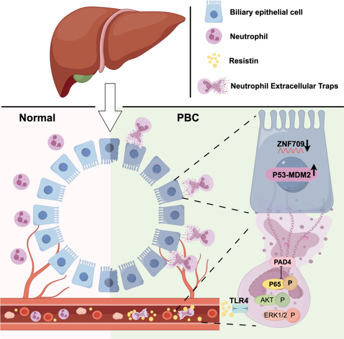 Neutrophil extracellular traps drive cholangiocyte injury via ZNF709–TP53–MDM2 pathway in primary biliary cholangitis