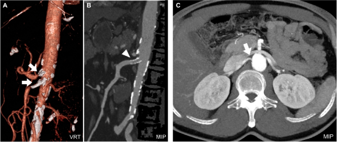 Visceral arterial disease: imaging features and pattern-based evaluation on CT angiography