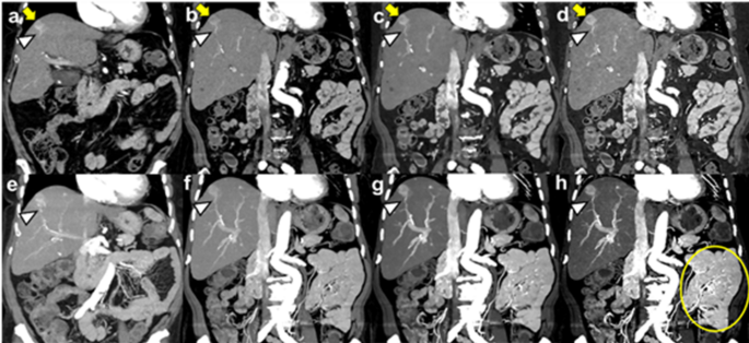 Seeing the invisible: practical strategies to maximize the clinical impact of photon-counting CT in abdominal imaging