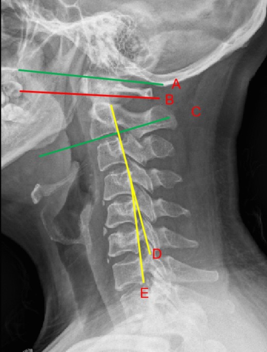 Predictive value of C0–C2 and C1–C2 angles for postoperative lower cervical alignment following posterior atlantoaxial fixation and fusion: a retrospective single-center study