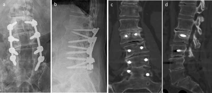 Lateral lumbar interbody fusion to address pseudarthrosis after prior posterior spinal instrumentation