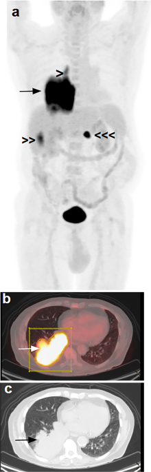 F-FDG PET/CT Metabolic Parameters Add Prognostic Information to Stage IV Classification in Patients with Non-Small Cell Lung Cancer