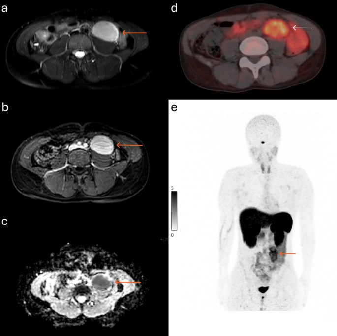Retroperitoneal Castleman Disease With Focal [⁶⁸Ga]Ga-DOTATATE Uptake