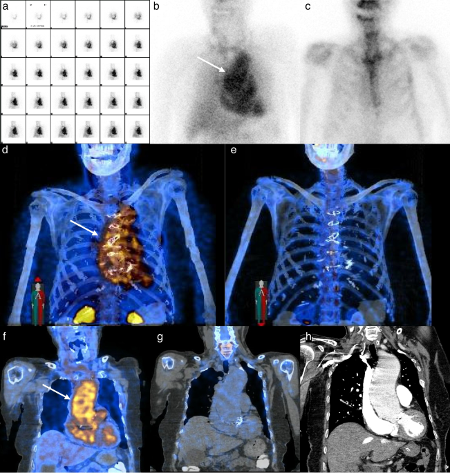 Incidental Detection of Thoracic Aortic Aneurysm on Three-Phase Bone SPECT/CT
