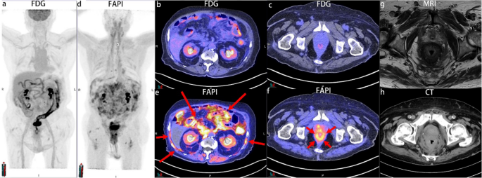 Ga-FAPI PET/CT Unveiling F-FDG Negative Peritoneal Carcinomatosis in a Rare Urinary Bladder Tumor