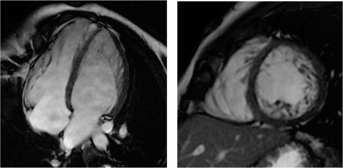 Left ventricular excessive trabeculation: pathophysiology, diagnostic challenges, and prognostic significance